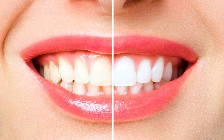 Teeth Whitening in Ahmedabad